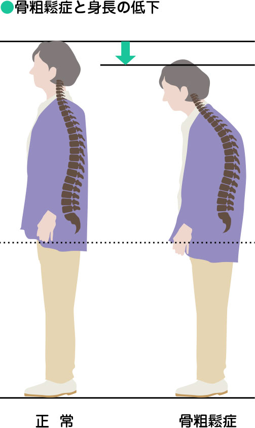 骨粗鬆症と身長の低下