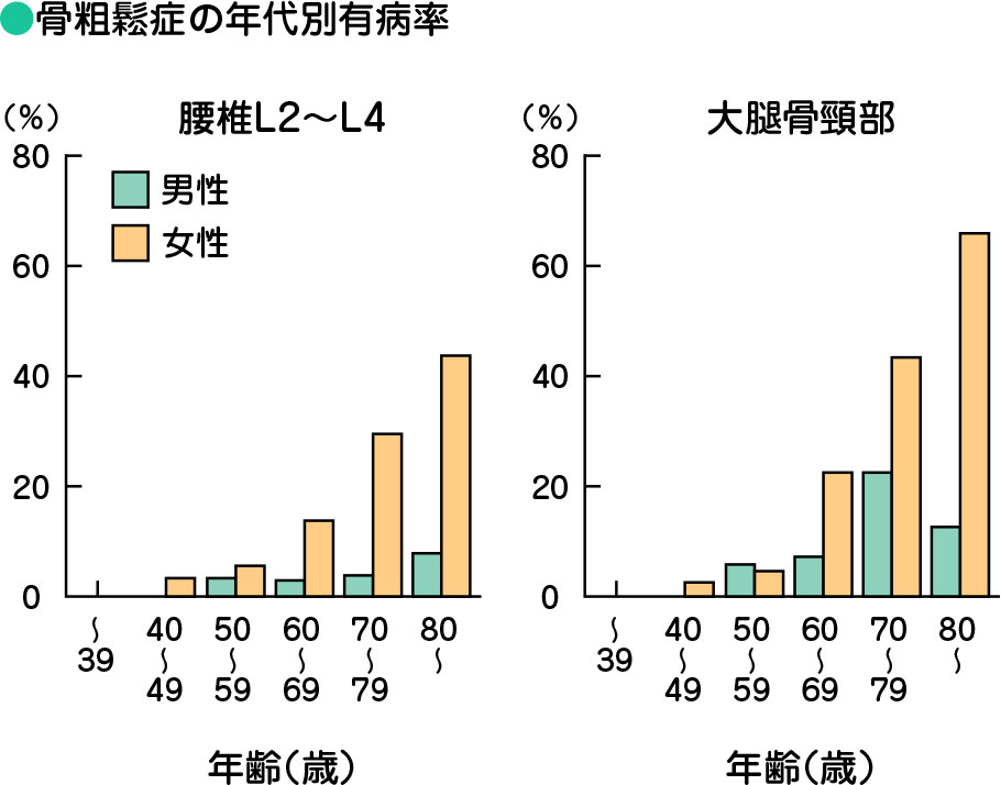 骨粗鬆症の年代別有病率